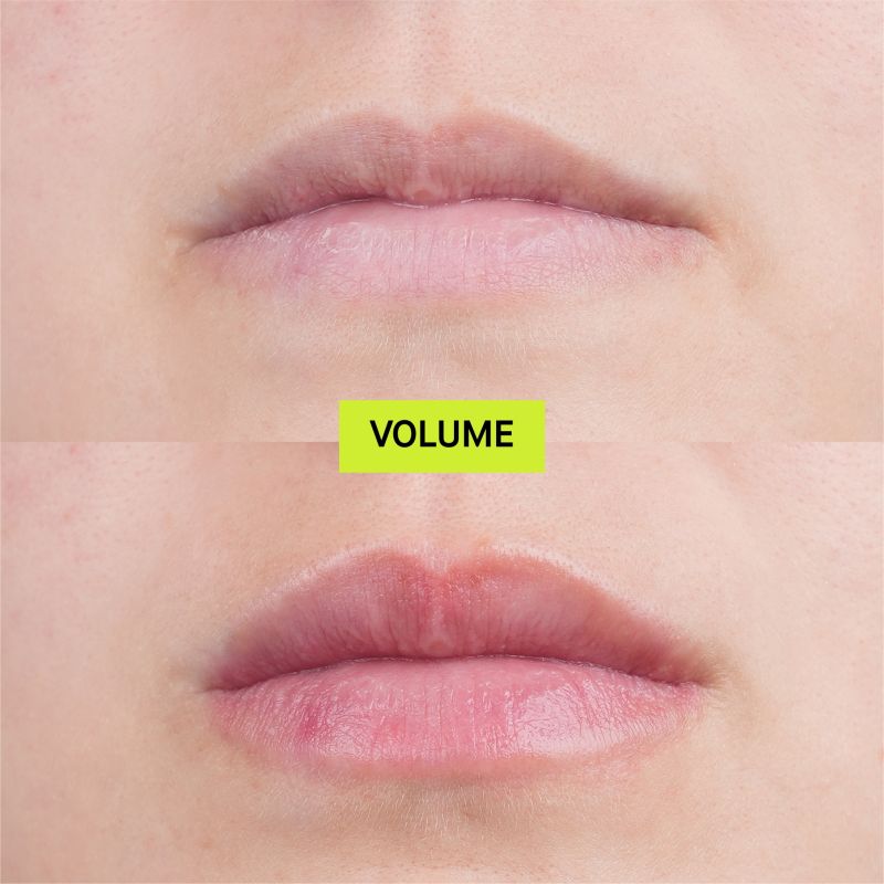 Volume (Hydro-Plump Lip Augmentation)