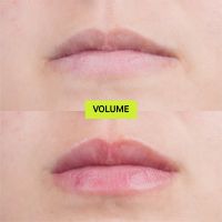 Volume (Hydro-Plump Lip Augmentation)